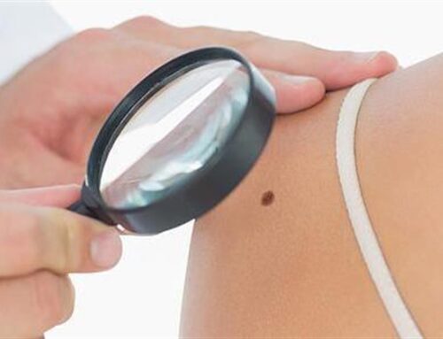 Το πρώτο τεστ για το μελάνωμα του δέρματος που εντοπίζει όσους δεν κινδυνεύουν με μετάσταση του καρκίνου
